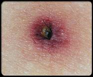 A tick latches onto skin, where it then feeds on blood.