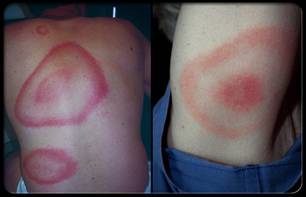 Lyme disease initially affects the skin, causing an expanding reddish rash similar to a target or bull's-eye.